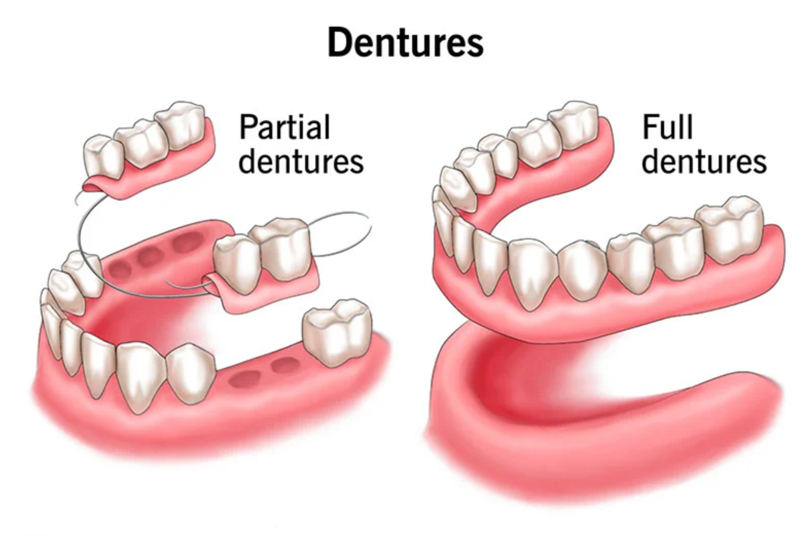 Example of Dentures